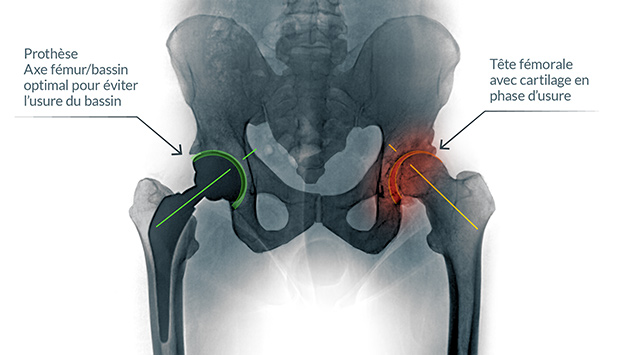 Schématisation des hanches montrant à droite une arthrose et à gauche une prothèse totale de hanche