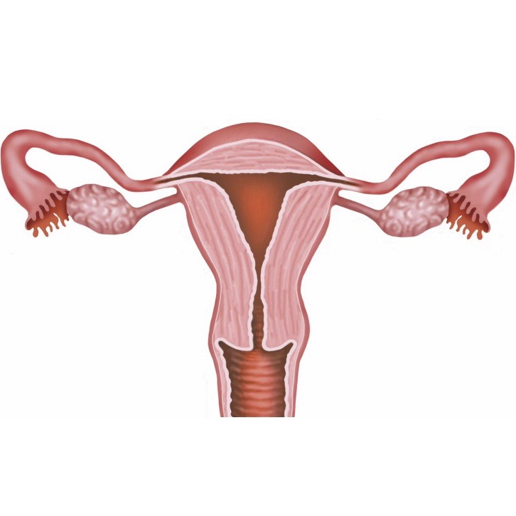 schématisation utérus impliqué dans l'endométriose