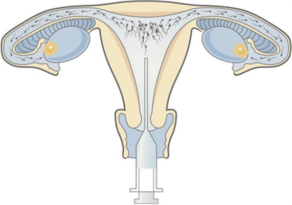 Insémination artificielle au niveau du col de l'utérus ou de la cavité de l'utérus de la femme