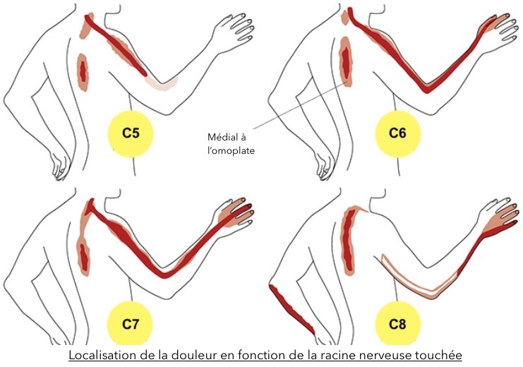 4 schémas pour illustrer les explications de l'ostéopathe sur la névralgie cervico-brachiale. Chaque nerf innerve des zones différentes et en fonction de la racine comprimée, le patient aura des douleurs différentes.